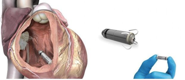 ARRIVA IN SICILIA LA “CARDIOCAPSULA”. IL PIU’ PICCOLO PACEMAKER AL MONDO IMPIANTATO A RAGUSA