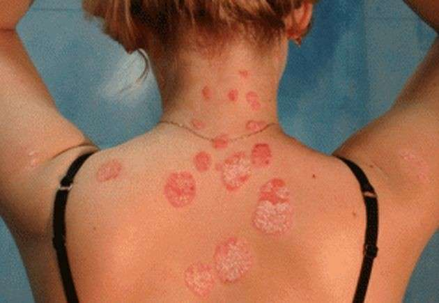 Psoriasi in aumento, il 28 ottobre visite gratuite in ospedale