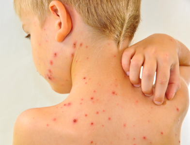 Morbillo: tasso di mortalità in crescita. Allarme di Simit anche in Sicilia