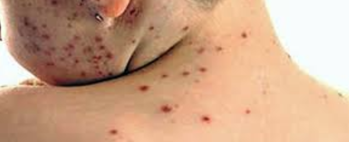 Emergenza morbillo, a Ragusa attivato piano vaccinazioni