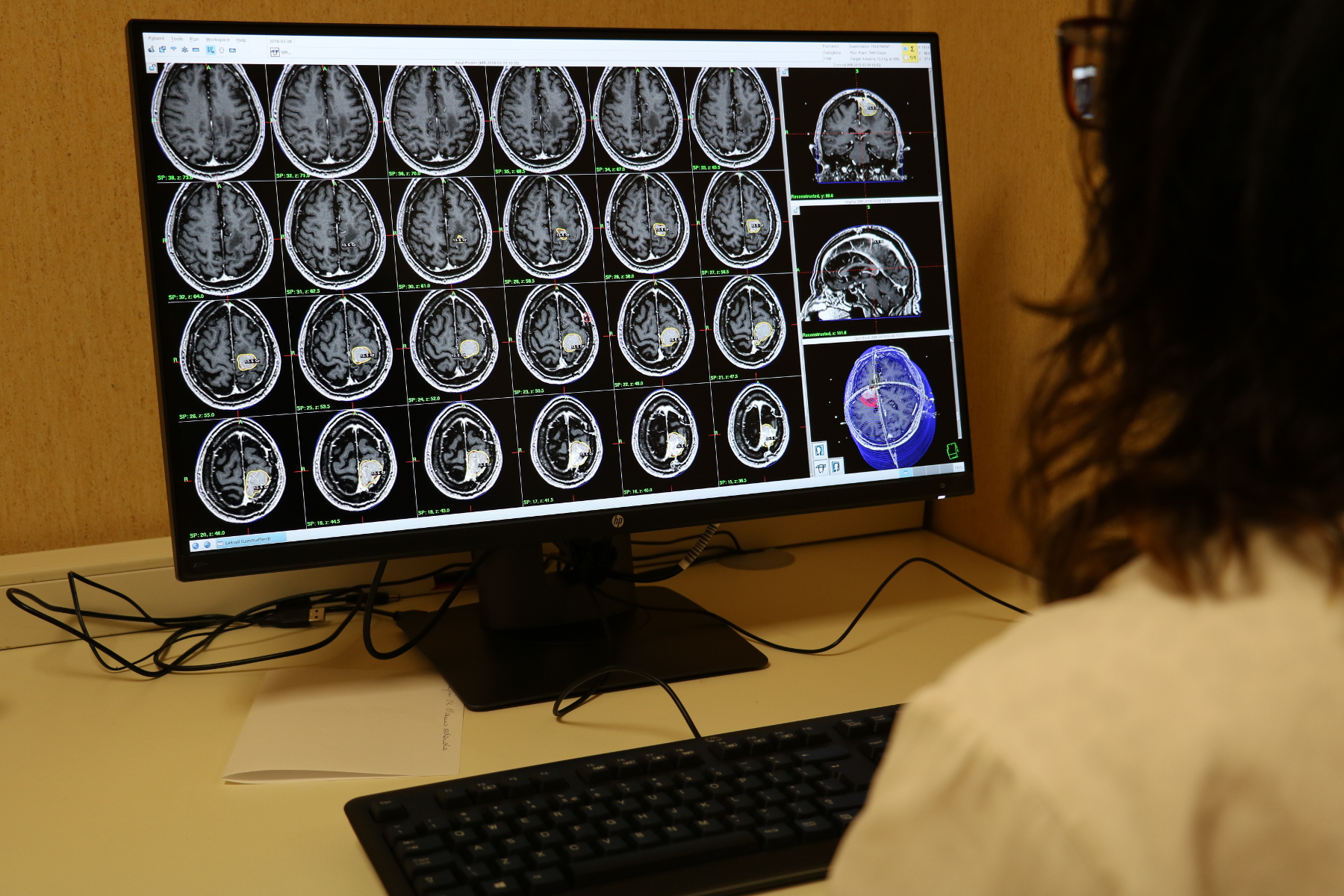 A Cannizzaro di Catania l’avvio delle cure tramite il Gamma Knife per la radiochirurgia stereotassica