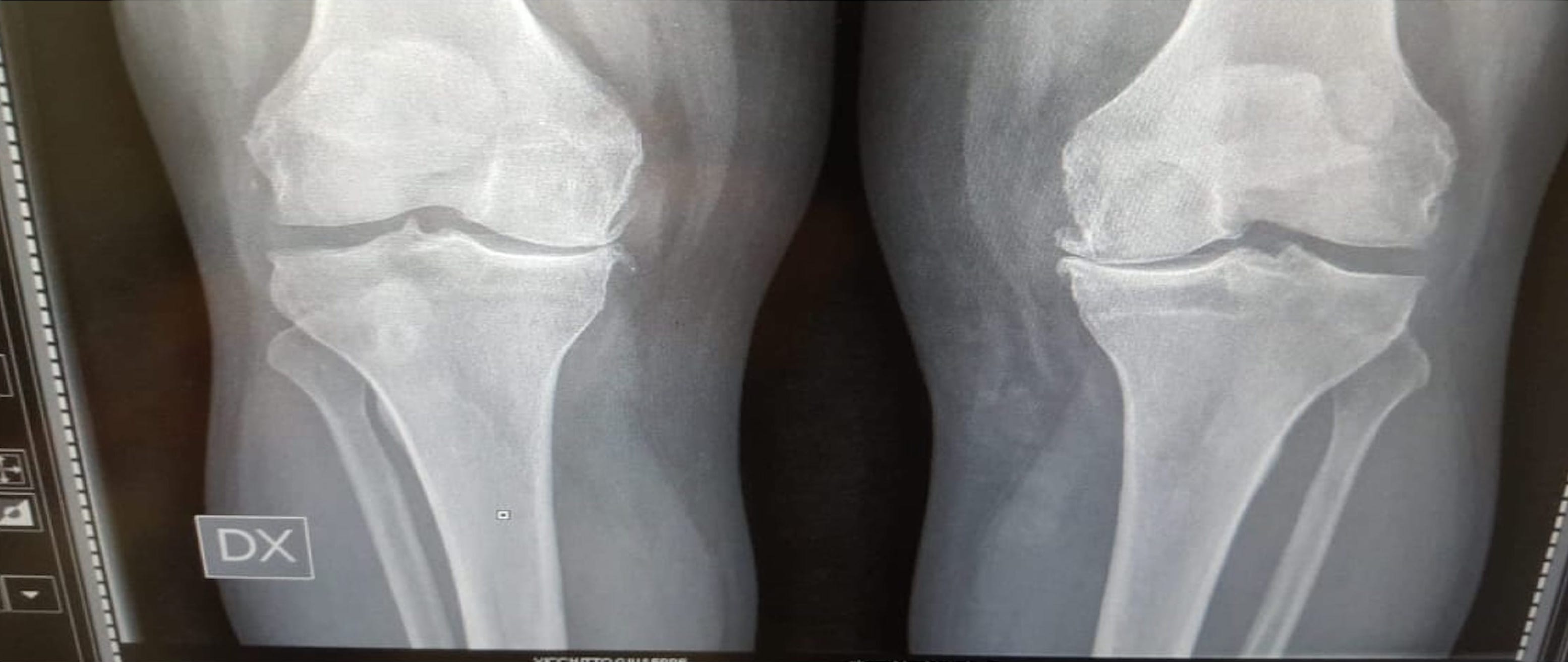 A Siracusa il convegno scientifico sulla osteoartrosi