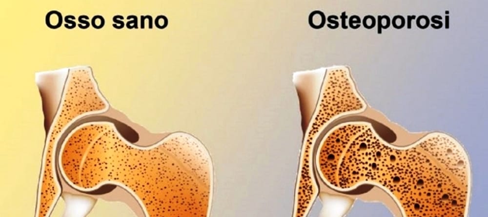 Osteoporosi, convegno dell’Avis di Chiaramonte