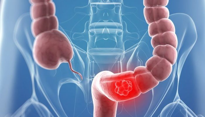 L’assunzione di antibiotici aumenta il rischio di cancro al colon. A dirlo i ricercatori della Johns Hopkins Cancer Center di Londra