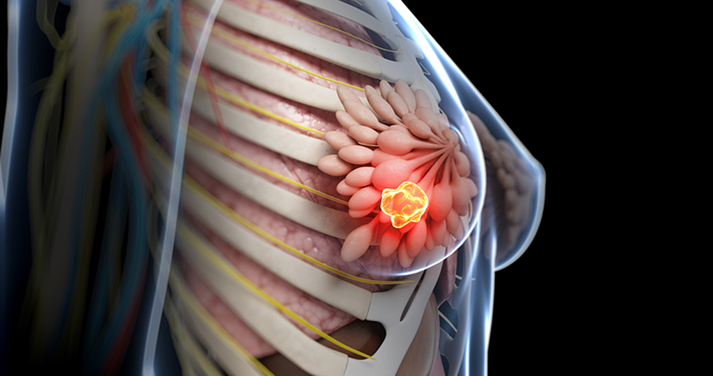 Obiettivo Breast Unit: Ragusa potrebbe diventare un punto di riferimento per la cura del tumore al seno