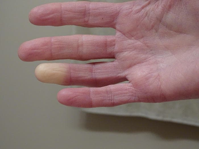 Sclerodermia, A Catania giovedì controlli gratuiti