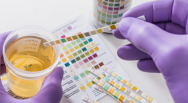 Cancro alla prostata: gli scienziati sviluppano un test delle urine a casa