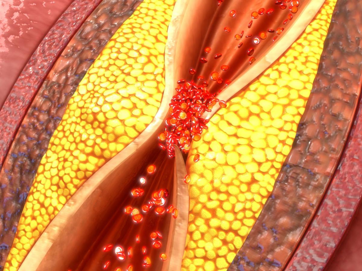 Si chiama “VITT”, la sindrome da trombosi rare dopo il vaccino. Quali sono le possibili cause? Lo studio