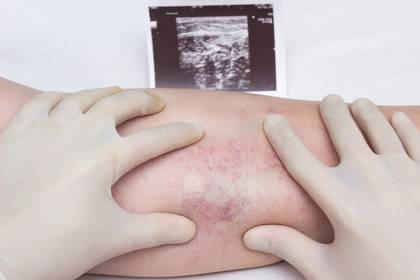 Vaccini, ematologo: Impossibile stabilire chi è a rischio trombosi