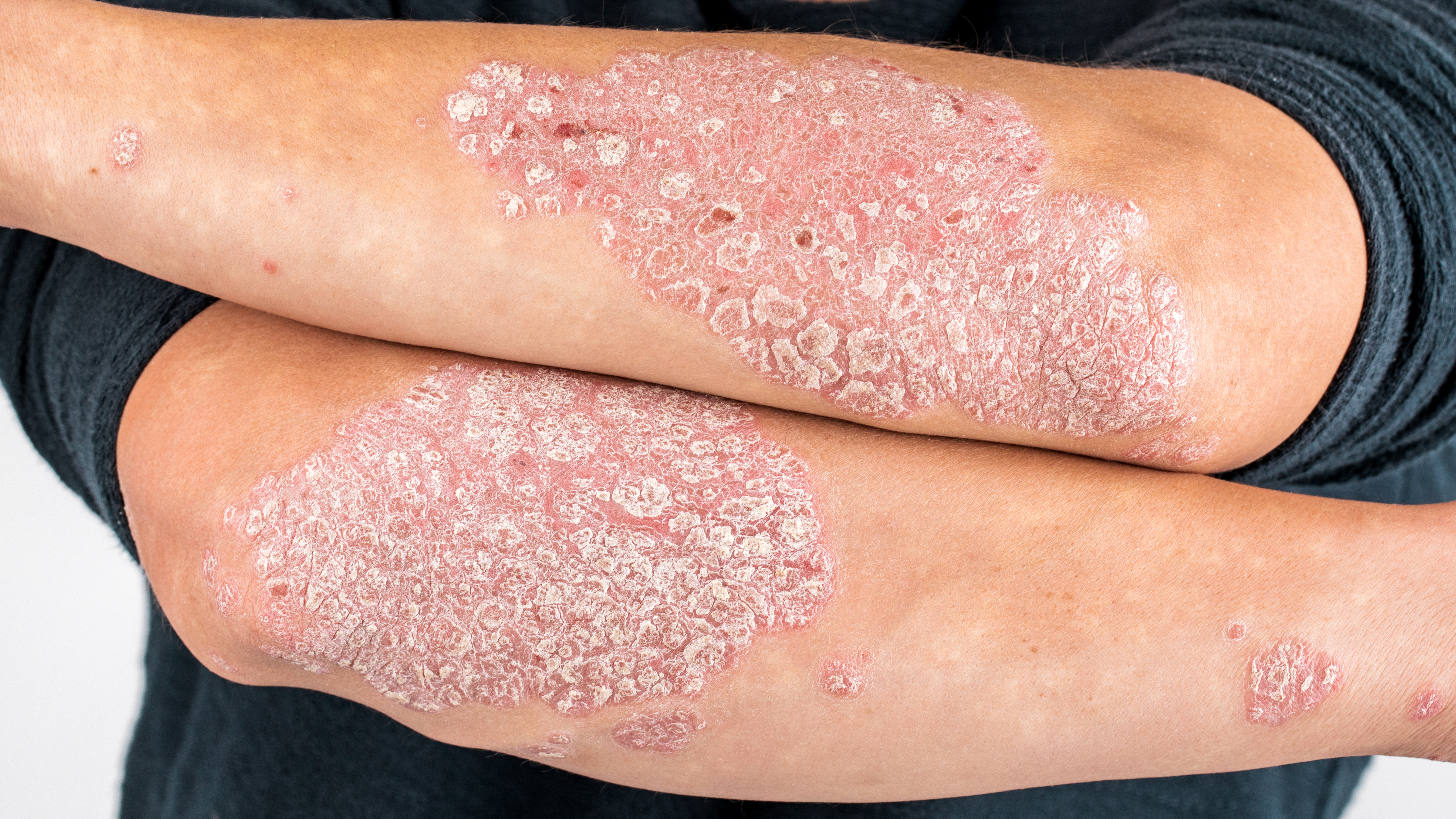 Psoriasi, la malattia che segna la pelle e l’anima: consulti gratuiti al “Busacca” di Scicli